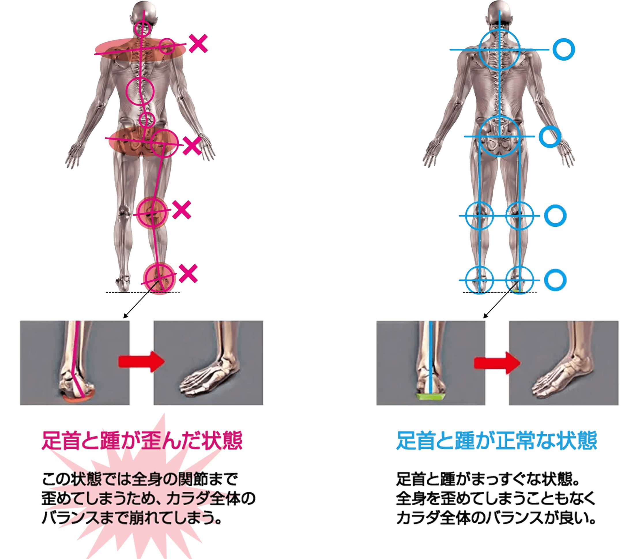 足首と踵が歪んだ状態 この状態では全身の関節まで歪めてしまうため、カラダ全体のバランスまで崩れてしまう。 足首と踵が正常な状態 足首と踵がまっすぐな状態。全身を歪めてしまうこともなくカラダ全体のバランスが良い。